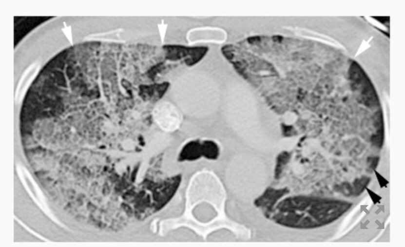 Jan_PrzMrls's tweet photo. Paciente que presenta dificultad respiratoria 48 h después de la fijación intramedular de una fx femoral. La TCAR axial muestra opacidades bilaterales en vidrio esmerilado y engrosamiento interlobulillar del septo que da como resultado el patrón de pavimentación loca.#HGZ1Art https://t.co/nqCClD0khv