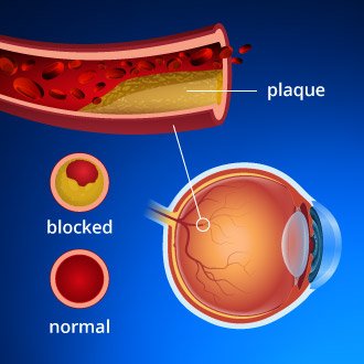 OphthalmoNeuro's tweet photo. #Eyestrokes occur when blockages (occlusions) occur in arteries or veins in the #retina, causing #visionloss 
#Neurology #ophthalmology #VisualSystem #Acupuncture #OpticNeuropathy #Diplopia
Share your research under this track https://t.co/ezoIf9g3CN https://t.co/6Lwph9BqgX
