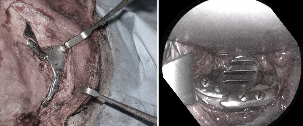 PDR_SPD's tweet image. Computer aided planning, 3d design &amp;amp; 3d printing/additive manufacture play a vital role in complex maxillofacial procedures. This video describes how @ShakMustafa at @CwmTaf used these methods to improve the safety &amp;amp; accuracy in a challenging case. vimeo.com/269165943