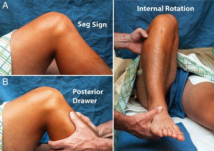 Journal Of Isakos On Twitter Preoperative Knee Laxity And