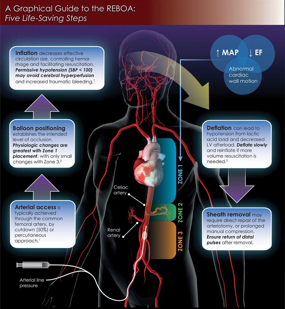 emilysharpe's tweet image. REBOA can be a life saving innovation in obstetric hemorrhage. Fantastic presentation by @JillMhyre #SOAPAM2018 #ptsafety #maternalmortality @APSForg