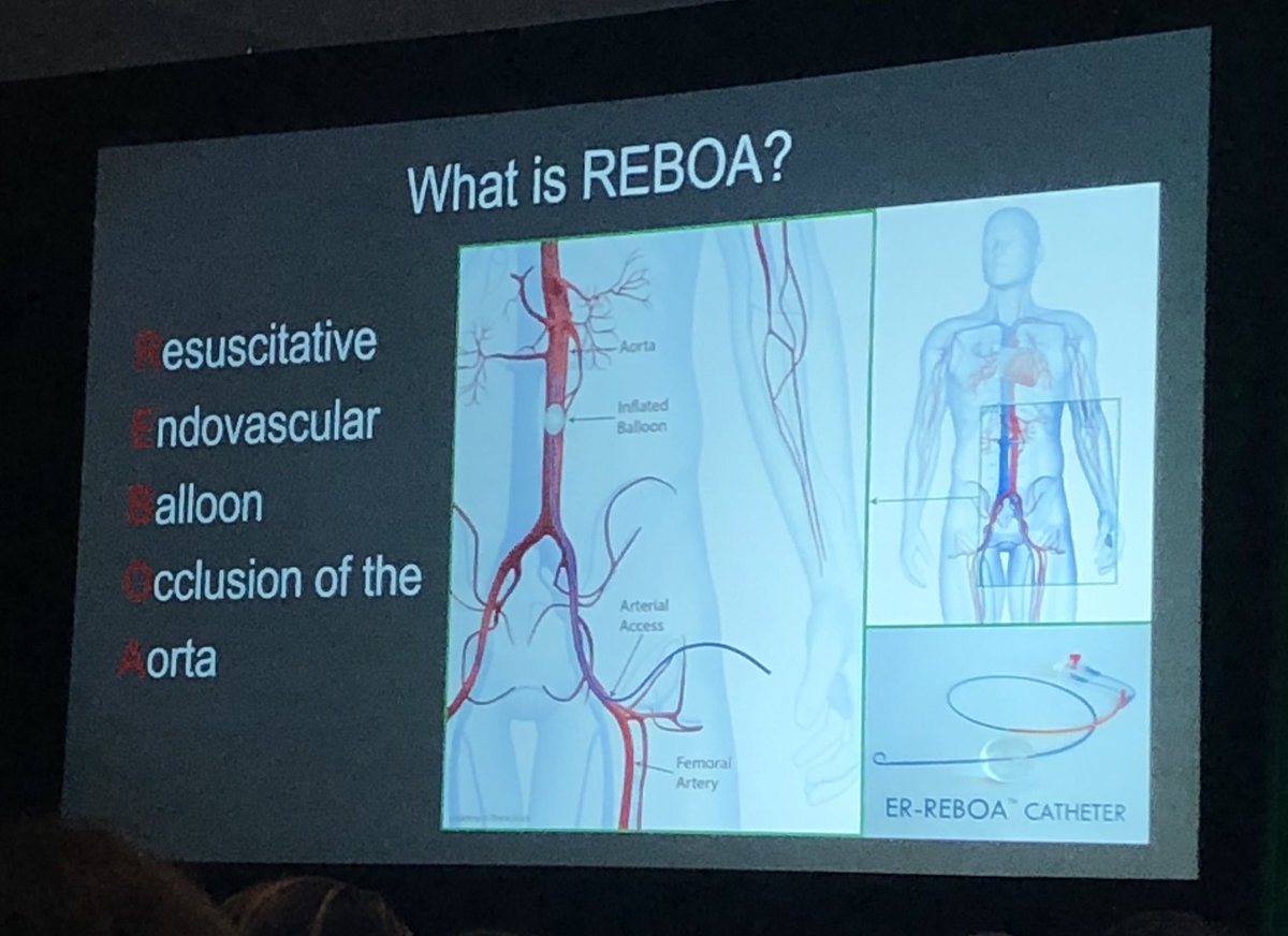 emilysharpe's tweet image. REBOA can be a life saving innovation in obstetric hemorrhage. Fantastic presentation by @JillMhyre #SOAPAM2018 #ptsafety #maternalmortality @APSForg