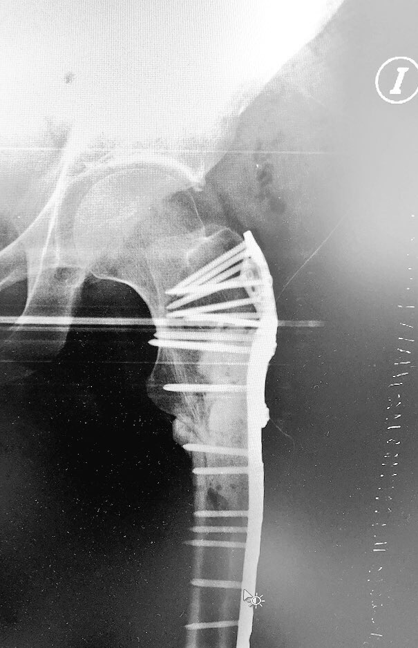 rupermac's tweet photo. New case of high-grade spindle cell #tumor in proximal femur where #Bedside3DPrinting has allowed us a complete surgical planning, shortening surgical time and improving resection margins.

@3d_maranon @GrupoGeis @soycot

#HospitalGregorioMarañon #healthinnovations #medtech https://t.co/lvP8ZMCnVs