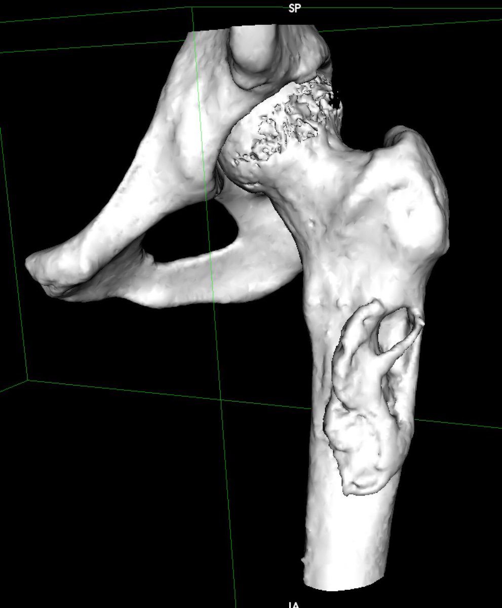 rupermac's tweet photo. New case of high-grade spindle cell #tumor in proximal femur where #Bedside3DPrinting has allowed us a complete surgical planning, shortening surgical time and improving resection margins.

@3d_maranon @GrupoGeis @soycot

#HospitalGregorioMarañon #healthinnovations #medtech https://t.co/lvP8ZMCnVs
