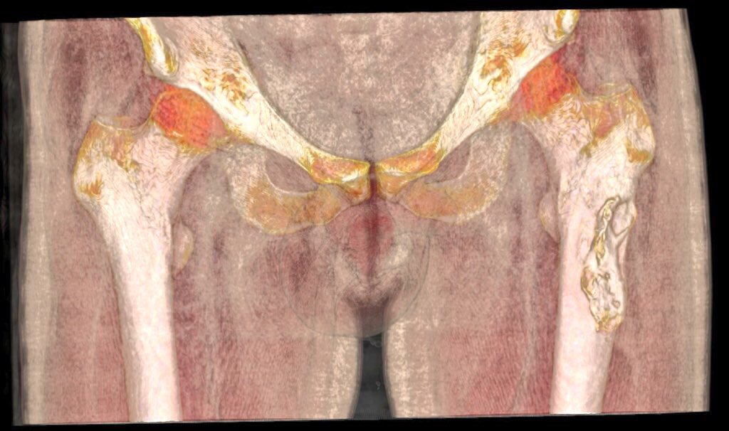 rupermac's tweet photo. New case of high-grade spindle cell #tumor in proximal femur where #Bedside3DPrinting has allowed us a complete surgical planning, shortening surgical time and improving resection margins.

@3d_maranon @GrupoGeis @soycot

#HospitalGregorioMarañon #healthinnovations #medtech https://t.co/lvP8ZMCnVs