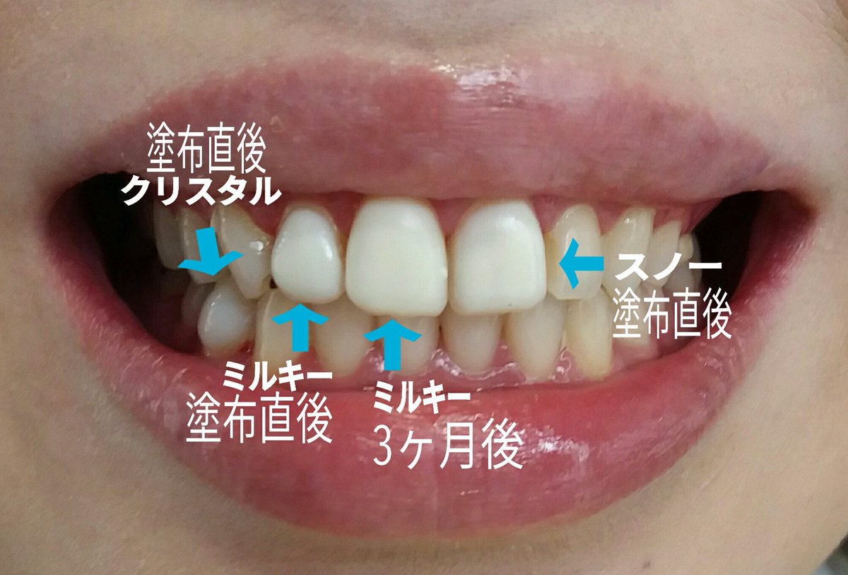 歯のマニキュアホワイトコート専門・歯科 (@Leila_Dental) / X