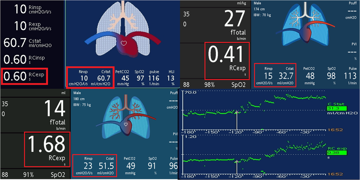 Ababilindia's tweet photo. Bedside tip: How to use the expiratory time constant

read more... https://t.co/GPWSooioYu

#MedicalDevice #Medical #health #healthcare #doctors #healthcarecompany #clinicalpractice https://t.co/sj1SNHWfQG