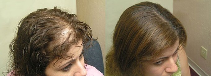 bgtrs.pro/?target=-7EA5Q…  Dick und seidig - ich habe das Problem mit dem Haarausfall in nur 1 Woche gelöst!In nur 2 Monaten habe ich all meine ausgefallenen Haare wieder bekommen