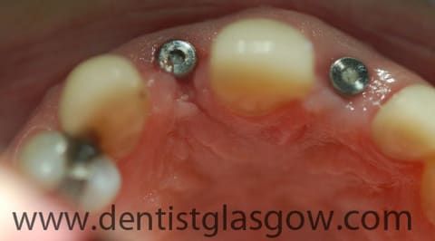 DentalAppletree's tweet photo. Jeanette needed dental implants but decided to shop around for the best price in Glasgow. She ended up coming to Dr Murphy and was very glad she did! https://t.co/3uxisAqKCL https://t.co/nyofH3Tvlk