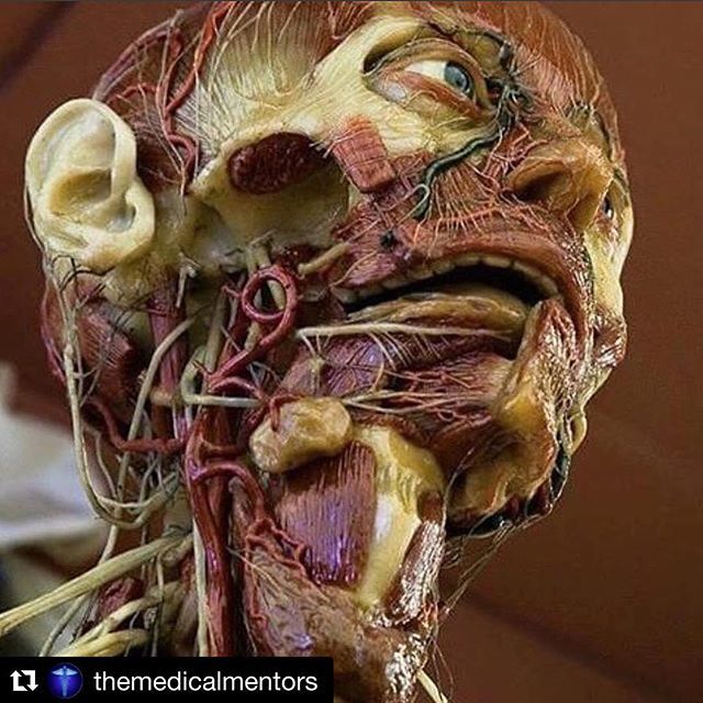 #Repost @themedicalmentors
・・・
A perfect dissection of the face! Many anatomical structures are visible here.For blood supply, We can see the common carotid artery branching into the internal/external carotid artery, as well  as the superficial tempo… ift.tt/2raBRuf