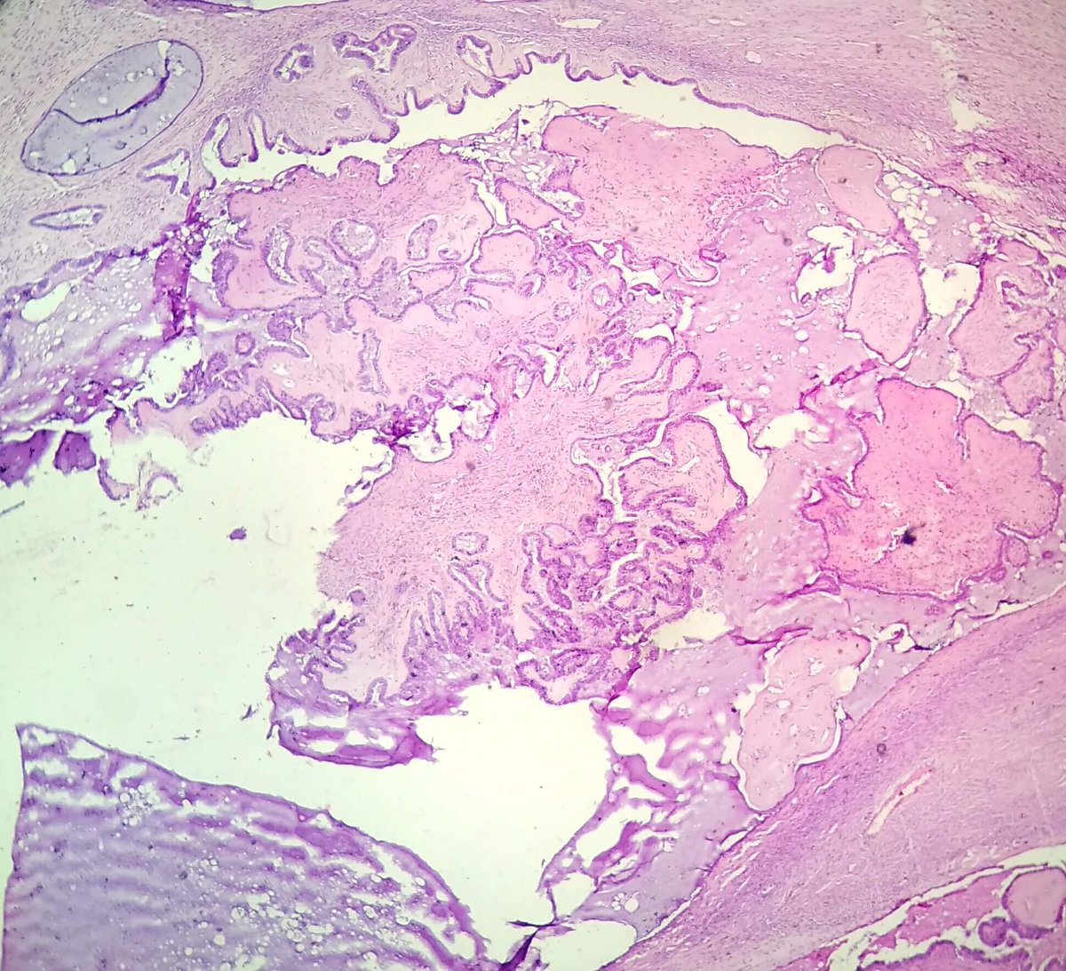 DrNishatAfroz2's tweet photo. Seromucinous borderline tumor ovary (first two images), Serous borderline tumor( last two images), 20YF, n 30 YF respectively !#Gynpath Pathology, #pathology
#pathogists https://t.co/hRAvLghyow