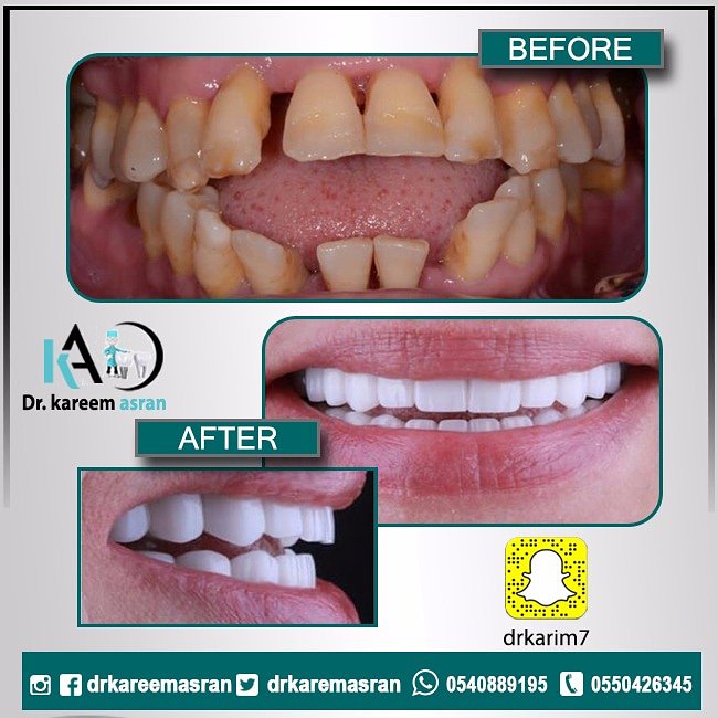 تصميم #الابتسامة ما يميزنا
حيث يتم #التحضير لها باحترافية
لتناسب #حجم_الأسنان و #لونها

#تقويم_اسنان
#زراعة_اسنان
#عدسات_اسنان