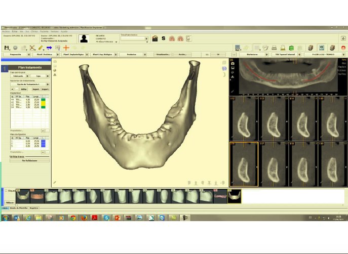 El software digital de <a href="/bucco_espana/">Bucco Dental Technology España</a> permite evaluar y planificar tratamientos rehabilitadores y estéticos y confeccionar tratamientos multidisciplinarios de última generación con impresoras 3D. #mockupdental #ortodoncia #diseñodesonrisas #ortodonciaestetica #planificaciondental