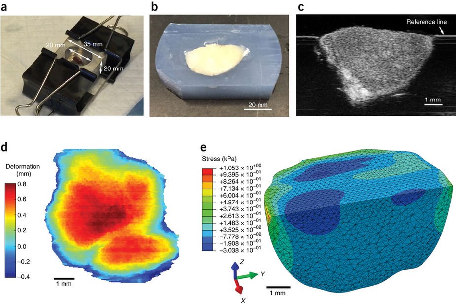 MGHSteeleLabs's tweet image. Quantifying #solidstress and #elasticenergy from
excised or in situ #tumors #PSON #physicalsciences #mechanics Congratulations @hadi_nia go.nature.com/2qnAUOC