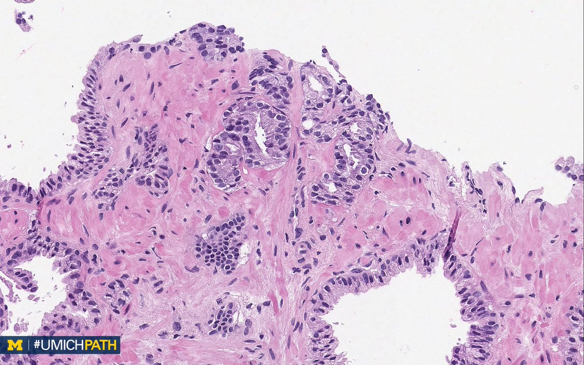 🔬 This week's #DailyDx theme: Prostate #Pathology ➡️ One of these things is not like the other! Can you tell which image is different from the others? ➡️ We’ll tweet the answer and some quick facts tomorrow! #UMichPath #GUPath