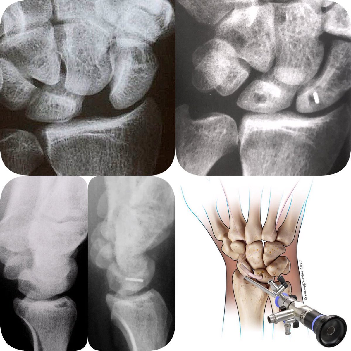 SL 360° reconstruction/dorsal capsulodesis arthroscopic