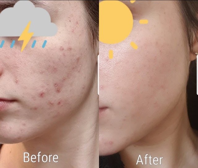 Whispered Din On Twitter Damaged Skin Barrier Vs 3 Months Later Healthy Skin Barrier Courtesy Of Skincare Addiction Reddit Https T Co Seiezigfnf Https T Co Axl9vtgb8r Twitter