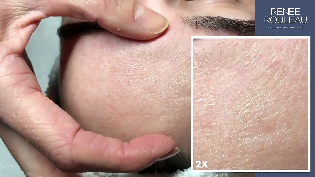 Whispered Din On Twitter Damaged Skin Barrier Vs 3 Months Later Healthy Skin Barrier Courtesy Of Skincare Addiction Reddit Https T Co Seiezigfnf Https T Co Axl9vtgb8r Twitter