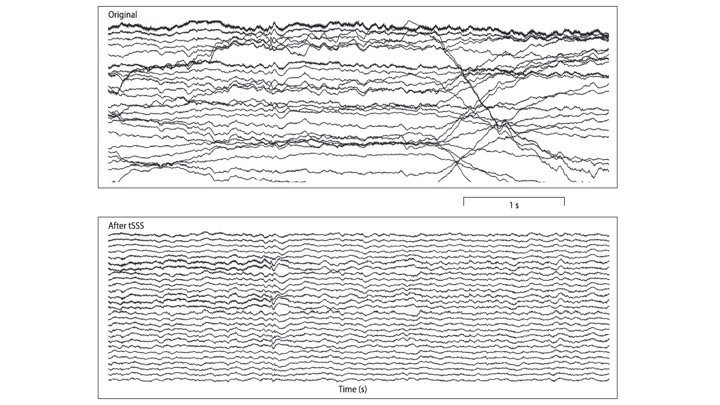 BrainsOnWaves (@aivoaalto) on Twitter photo Clinical Neurophysiology was quick 😀 The final version is now online. Open access. Enjoy! @aina_puce <a href="/mshamalai/">Matti Hämäläinen</a> @Joachim__Gross @neuosc <a href="/aivoAALTO/">BrainsOnWaves</a> doi.org/10.1016/j.clin… Clinical Neurophysiology was quick 😀 The final version is now online. Open access. Enjoy! @aina_puce <a href="/mshamalai/">Matti Hämäläinen</a> @Joachim__Gross @neuosc <a href="/aivoAALTO/">BrainsOnWaves</a> doi.org/10.1016/j.clin…