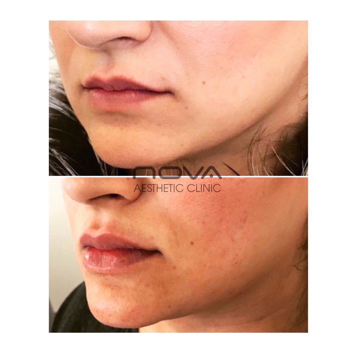 💥LIP FILLER OFFER at Nova💥 We’re offering half ml of lip filler for just £195 instead of £250! Limited space available. Treatment can be carried out within one month but MUST be booked before Saturday 12 May! Check our Instagram for full T&amp;Cs. 😍💋 #Greenwich #lipfiller #offer
