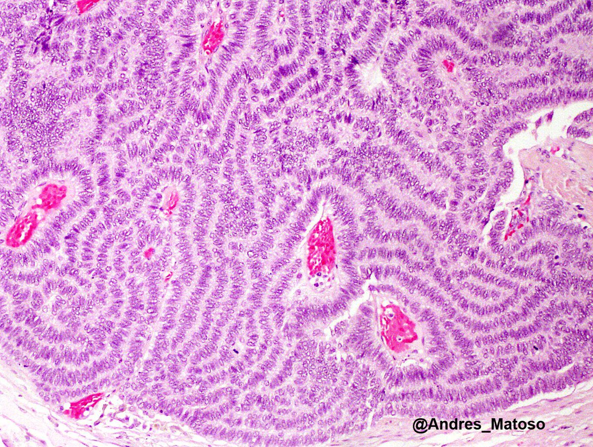 Andres_Matoso's tweet photo. Tightly packed cords of tumor cells is the most frequent pattern observed in kidney carcinoids. Rare but cute. #gupath https://t.co/F4lZGlUsxo