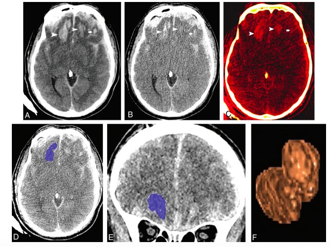 read fib 12 punching of