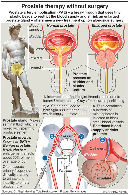 Prosztata adenoma és úszás