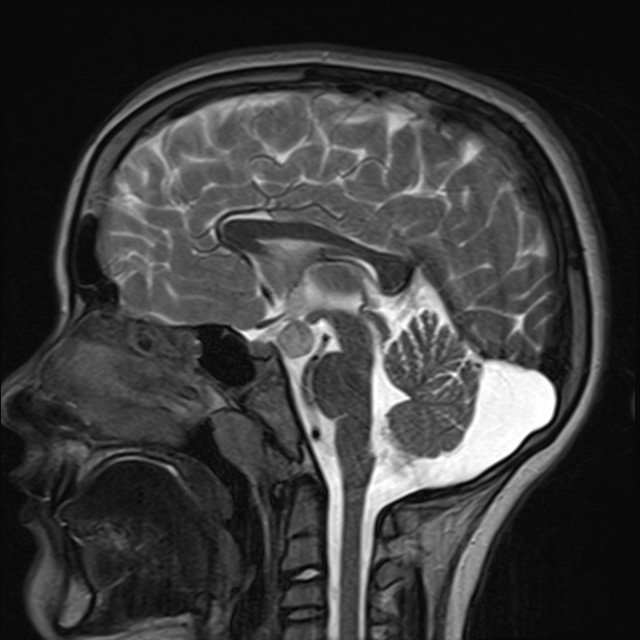 JennyKHoang's tweet photo. Girl with precocious puberty. We diagnose a tuber cinereum hamartoma! #Neurorads #valuebasedimaging

Known for gelastic seizures but precocious puberty is another presentation.   

See how here: https://t.co/DBq5j0oFCx https://t.co/aRJBtEQ0od