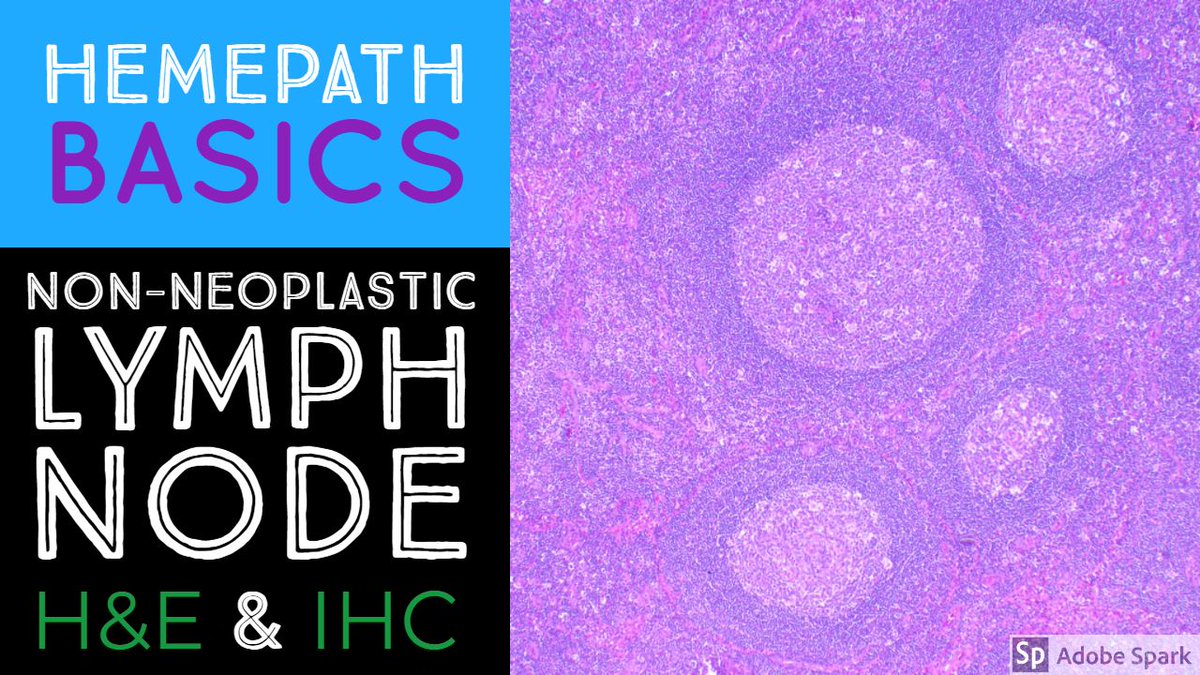 Special #hemepath guest on my YouTube channel: Dr. Jeanette Ramos teaches me &amp; @ehfultonmd basic #histology &amp; #IHCpath of non-neoplastic lymph nodes. buff.ly/2KuJ7tJ If you like this, let me know. Should I invite other special guests in future? #pathology #pathologists
