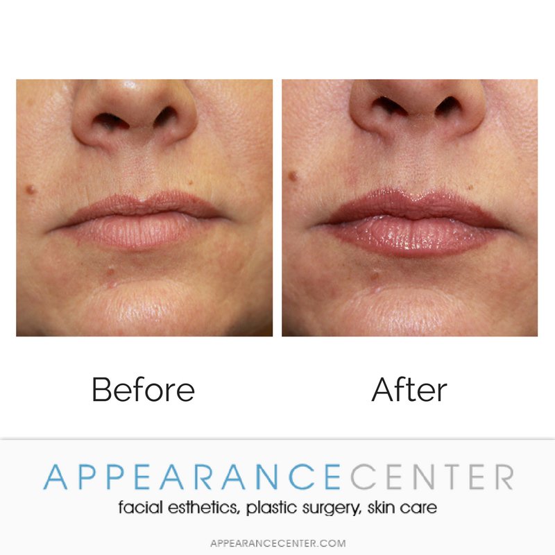 AppearanceCNTR's tweet photo. Lip fillers can be naturally plump and proportionate with your face with the help of the right physician and the right filler.@DainesMD carefully filled this patient's #lips to create a naturally full pout. Call to schedule a consultation: (949) 200-1615 https://t.co/Qe0KvKwhej