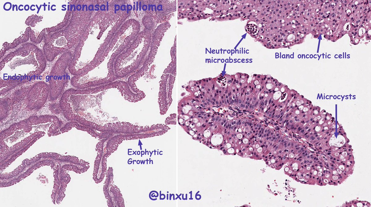 BinXu16's tweet photo. Sinonasal papilloma side-by-side comparison with a bonus summary table. #ENTpath #pathobard #pathology101

@TheKarenPinto @kriyer68 @DrAhmedKalebi @kabeerkshah @aakasharmand @smlungpathguy @sam_albadri @Sara_Jiang @bansar_bansaria @ycharzy @DrAldehyde @luishcruzc @DrGeeONE https://t.co/oSEGskmuTc