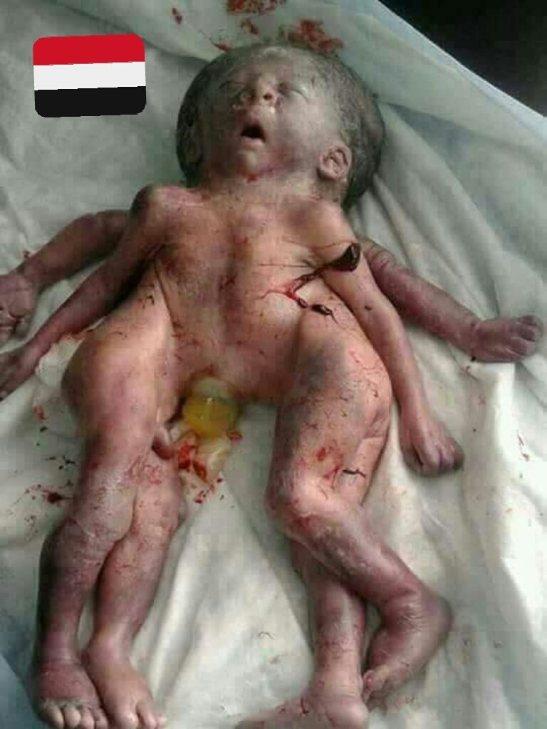 Y_E_Mx's tweet photo. 🚨 WARNING ⚠ 

Today, creating this Twins in the district Sohar, so generates most of our children in saada, and in #YEMEN. in general, the result of the bombing in arms the forbidden internationally by Alliance, led by Saudi Arabia, backed of America, Britain, France. 💔💔😢👇 https://t.co/4OZplU2aCA