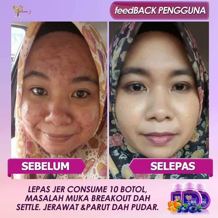 CheHayatie's tweet photo. MUKA BREAK OUT TERUK 😫

Tersalah pakai skincare la pulok!
Lepas consume 10 botol
Masalah settle..
Parut dan jerawat dah pudar
#dianzlegacy
#dianzvitaminCE
#hisaphisapteruscantik
#trustedbrandsince2012
#readystock
#CodAndPosavailable
#freeGiftsAdded
#teamhotmama
yatie-0195414945 https://t.co/9eoL1v45xn