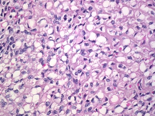 KZGIPath's tweet photo. Signet ring stromal tumor of the ovary, very rare but with great practical importance. Easily mistaken for Krukenberg tumor. Negative for keratin, PAS, and mucin. Benign. https://t.co/EMXIuyDJvA