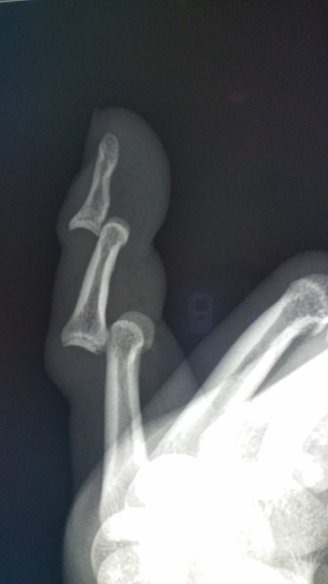 KhuranaBharti's tweet photo. Double dislocation #mskrad #mskerad #EmergencyMedicine #FOAMed #radiology #Radres @ASER_ERad https://t.co/MXbaKPhDcU