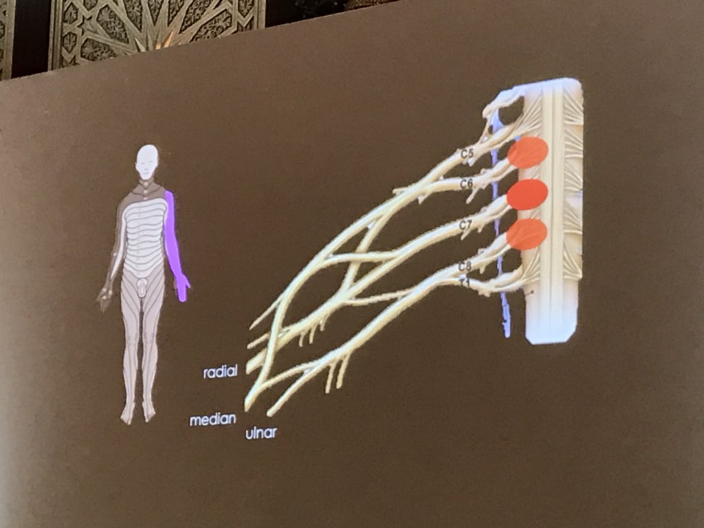 alisongrimaldi's tweet photo. Annina Schmid #PhysioUAE2018 symptom distribution can spread beyond area of nerve distribution in peripheral entrapment neuropathy -  due to neuroinflammation in spinal cord - multiple nerve roots become involved https://t.co/zOl8rRH66r
