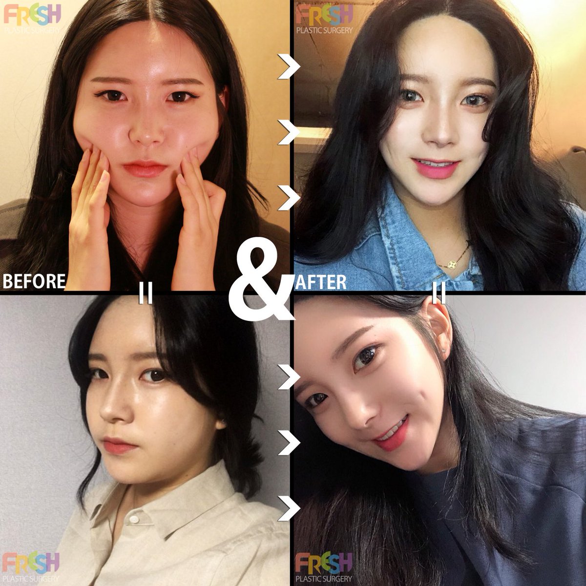 フレッシュ整形外科 Di Twitter 顔の脂肪吸引 涙袋フィラーで大変身 お問合せはラインにてお願い致します フレッシュ整形外科 脂肪 整形 脂肪吸引 輪郭術 脂肪移植 フィラー 涙袋 韓国整形 美容整形 プチ整形 モデル カロスキル 症例者