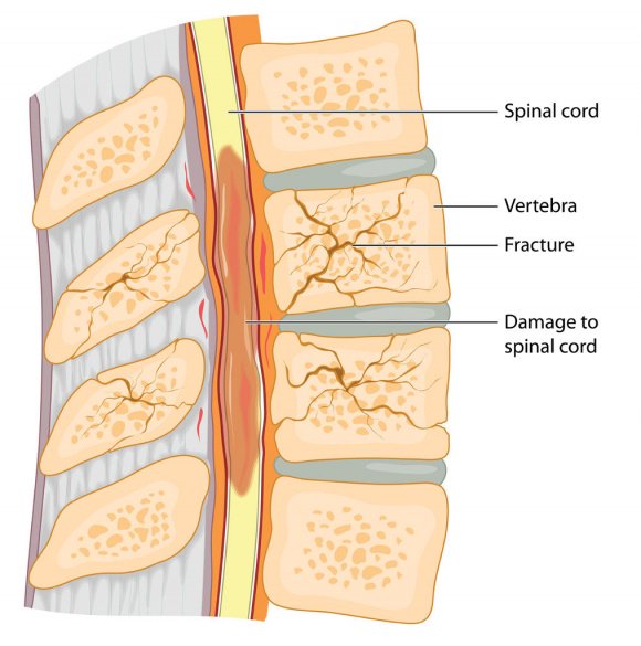 Why Timing Matters Spine Surgery After Spinal Cord Injury: ow.ly/S7QK30jsdje