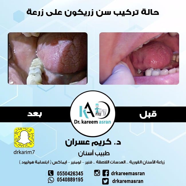 الآن لدى #الدكتور #كريم_عسران
مع #زراعه_الاسنان و #تركيبات_الزيركون #المضمونة

#عدسات_اسنان
#تقويم_اسنان
#زراعة_اسنان