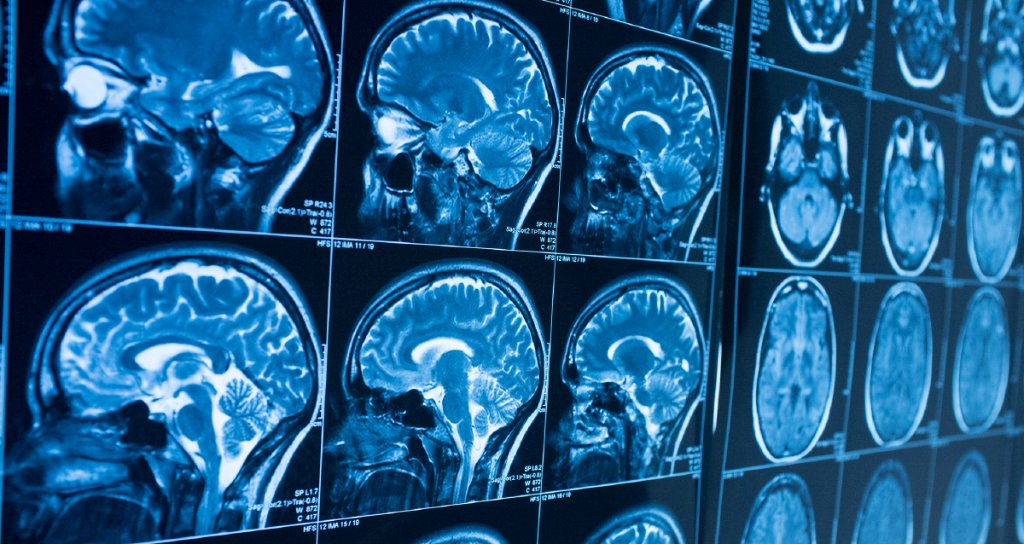 WebMD's tweet image. Could the popular party drug ecstasy help people suffering from PTSD? A new study suggests yes. wb.md/2KyvidE