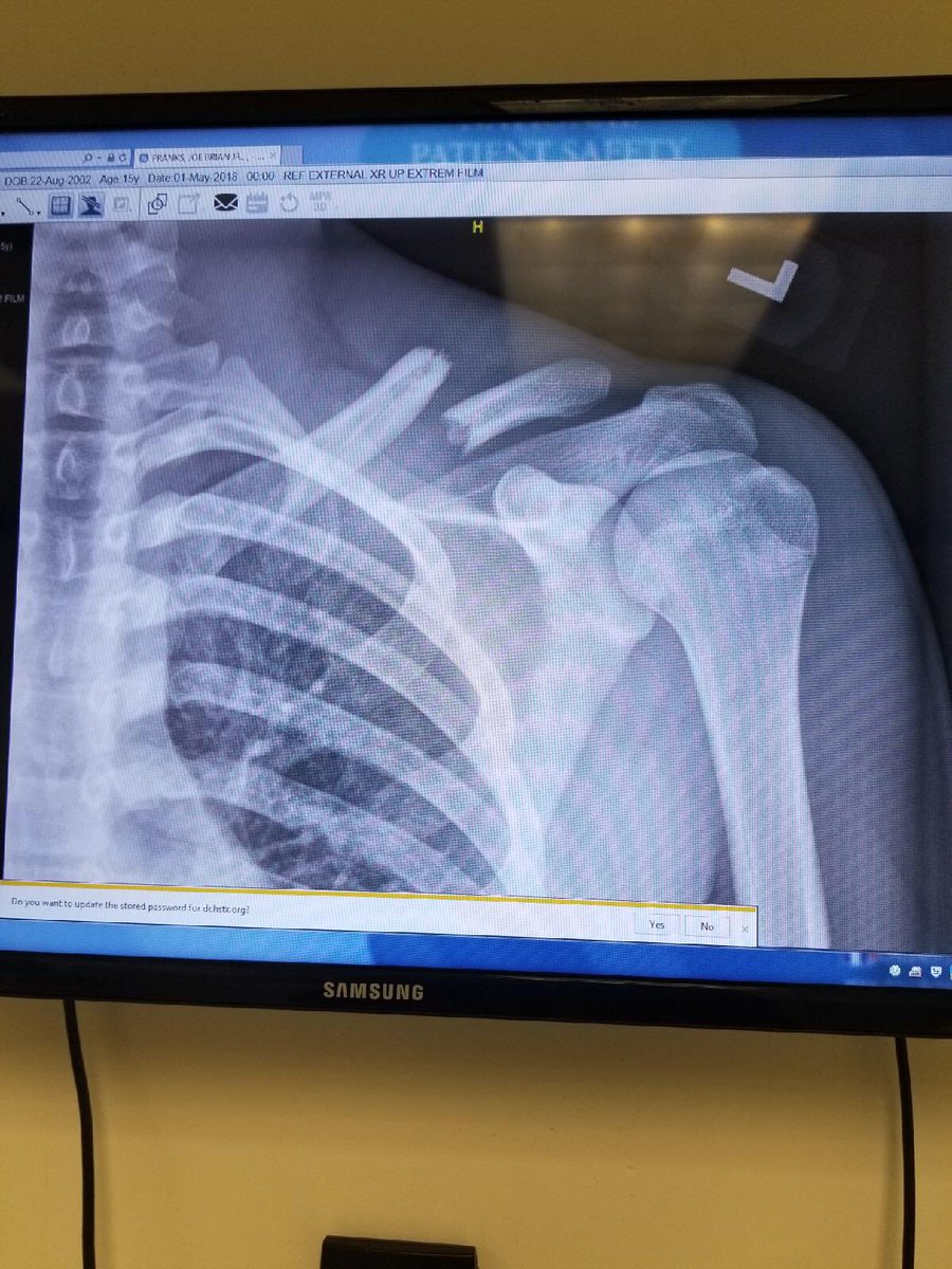 justbeingme0183's tweet photo. Joejoe’s broken clavicle #football #7on7 #practice #broken https://t.co/mmnJhE0PFt