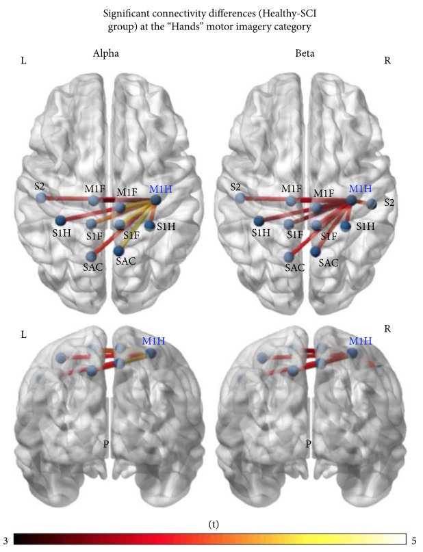 AlkinoosAthans's tweet photo. Enjoy our latest study on #brain_networks in the context of #spinal_cord_injury with @bamidis at @Hindawi 's reputable #Neural_Plasticity journal #EEG #functional_connectivity #SCI : https://t.co/Qw1gRMFzgI https://t.co/cmkoETqjia
