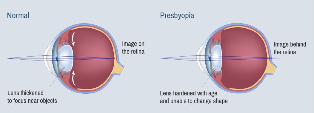 ConestogaEye's tweet photo. After age 40, the single pair of glasses or contact lenses you previously wore generally will no longer give you clear vision at all distances — or at least not without some compromises. https://t.co/vdsMpoNxvg