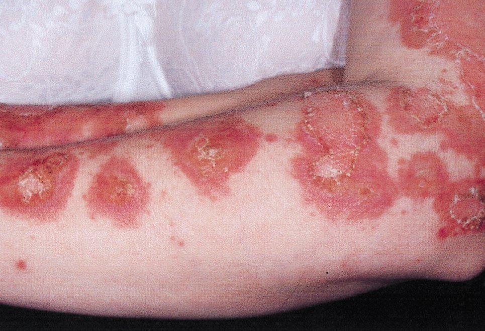 Patients with cutaneous #lupus erythematosus have an increased prevalence of co-existing #autoimmune conditions compared to the general population. Learn more ja.ma/2rgbF2i