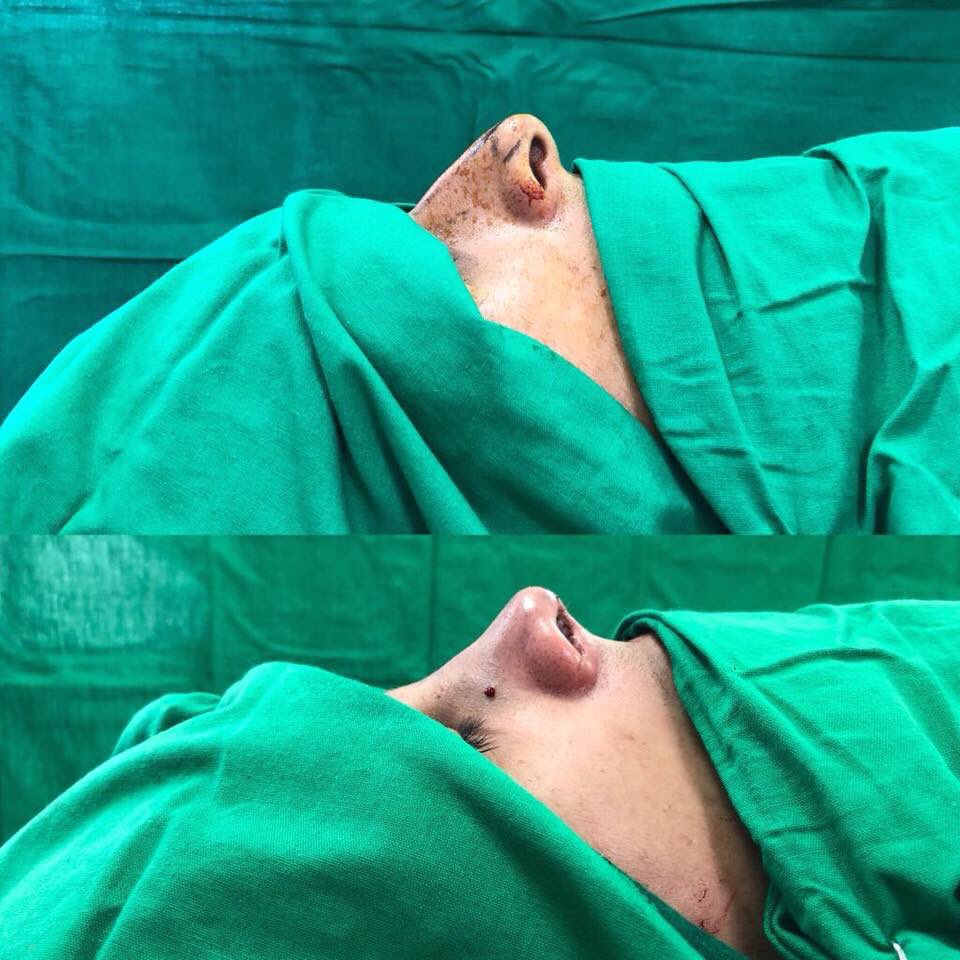 cesaremartinezc's tweet photo. En imágenes, el pre y post de una #Rinoplastia en el día de hoy.
¡Reserva tu consulta de valoración!
En Ibagué (8) 2669395.
Resto del país Cel/WhatsApp +57 317 659 5148 https://t.co/IrcL6R9CsN