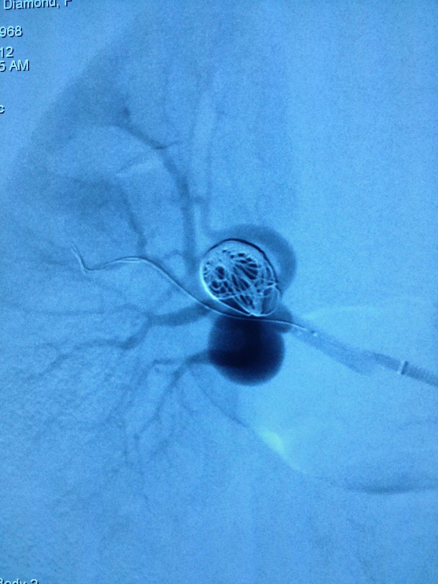 CUVascularSurg's tweet photo. Renal artery aneurysm embolization in a young female. @CUVascularSurg @CUDeptSurg @ColoradoIR @UofTVascular @UWVascsurg @jmills1955 @stanfordvasc @AlexCVIR @TYB4CUT_OJ #anatomyofasurgeon #wireup https://t.co/sqtgJAl4UB
