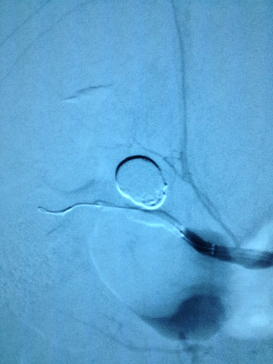 CUVascularSurg's tweet photo. Renal artery aneurysm embolization in a young female. @CUVascularSurg @CUDeptSurg @ColoradoIR @UofTVascular @UWVascsurg @jmills1955 @stanfordvasc @AlexCVIR @TYB4CUT_OJ #anatomyofasurgeon #wireup https://t.co/sqtgJAl4UB