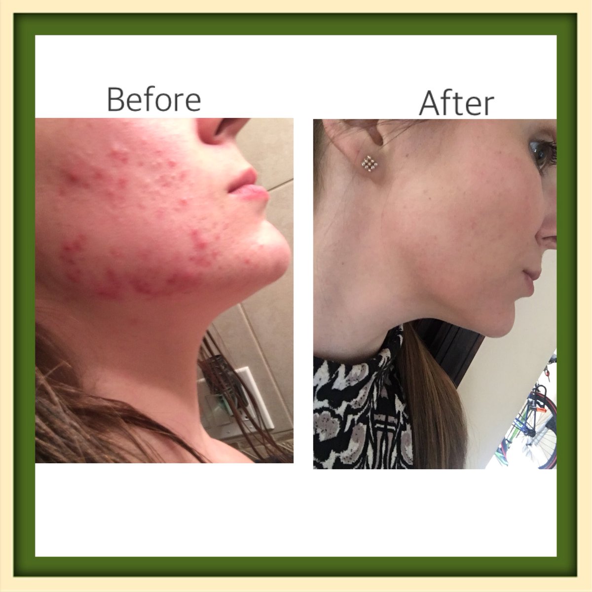 This was my skin 2 years ago... now look at it! thanks to @arbonne ‘s premium, pure, safe, and beneficial products! #transformation #pureproducts #veganskincare #acnetreatment #toxinfree #noanimaltesting #acne #nopreservatives #healthyskin #ibelieve #clearskin #safeskincare