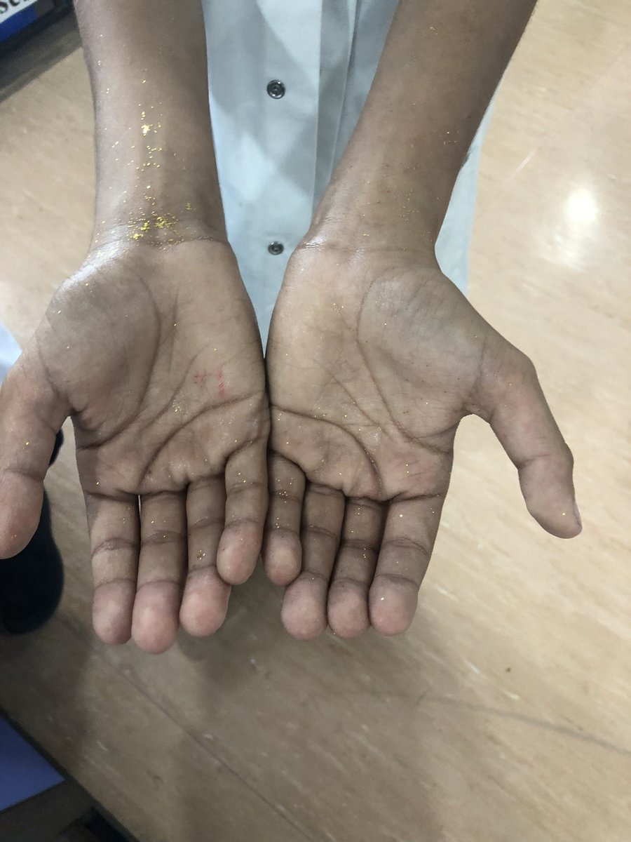 AIS_Grade6's tweet photo. Science investigation about germs using glitter to represent those horrid little microbes. How can we best clean our hands - water or soap or sanitiser? What do you think? And the winner is....soap and water 👏🏼 #AISscience #AISmiddleschool https://t.co/jRTd2Krcsj