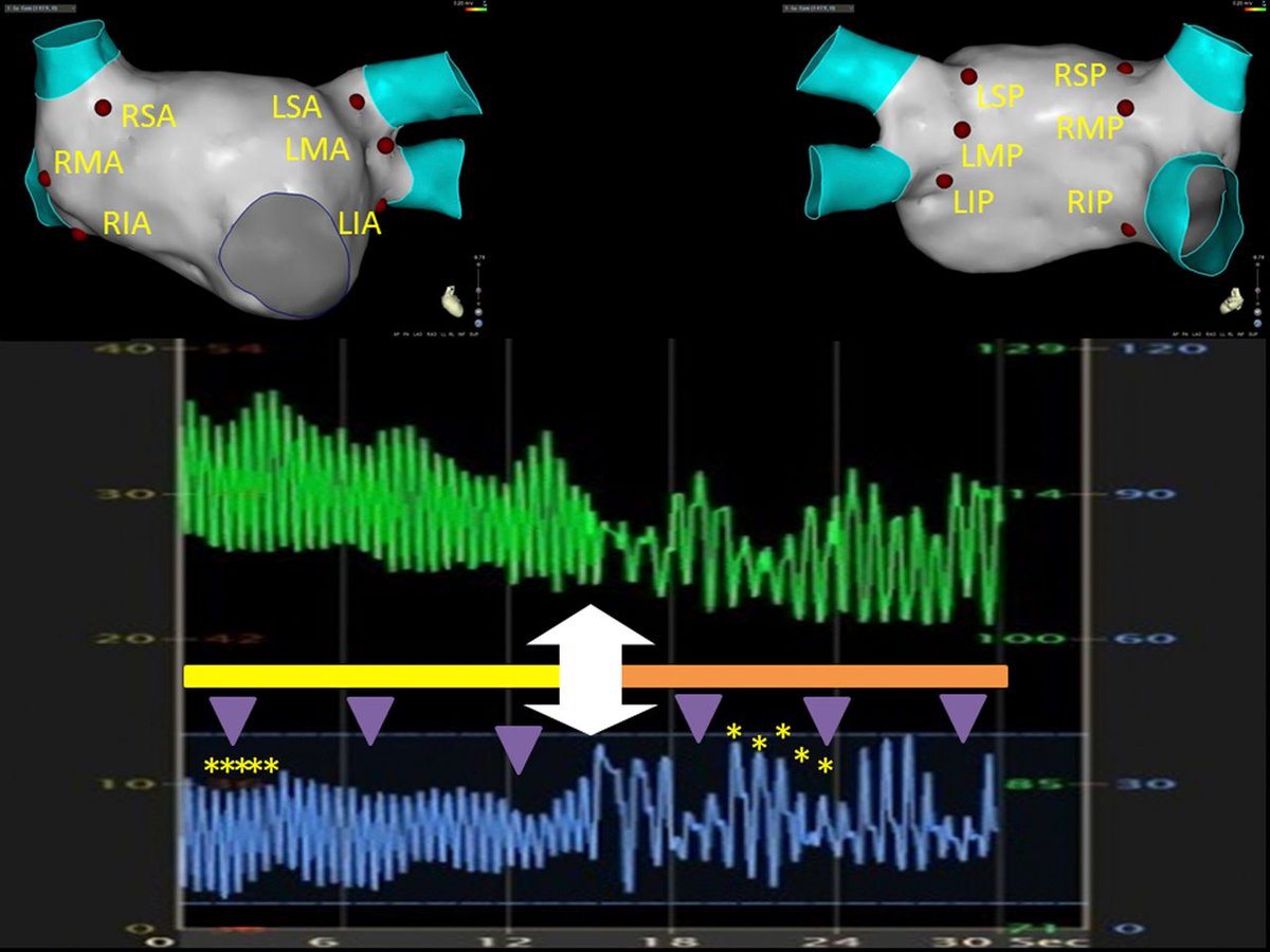 JACC Journals (@jaccjournals) on Twitter photo Rapid atrial pacing--another method to optimize lesion quality in #AFib ablation: ow.ly/FZeP30jNssl. #JACCCEP @azrielleib <a href="/CRB_EP/">Chirag Barbhaiya</a> Rapid atrial pacing--another method to optimize lesion quality in #AFib ablation: ow.ly/FZeP30jNssl. #JACCCEP @azrielleib <a href="/CRB_EP/">Chirag Barbhaiya</a>
